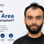 What Is the Donor Area in a Hair Transplant
